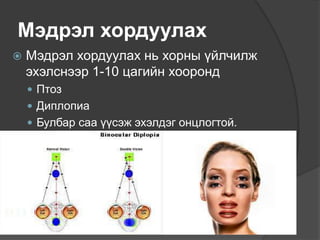 Мэдрэл хордуулах
 Мэдрэл хордуулах нь хорны үйлчилж
эхэлснээр 1-10 цагийн хооронд
 Птоз
 Диплопиа
 Булбар саа үүсэж эхэлдэг онцлогтой.
 