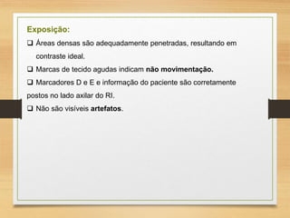 Exposição:
 Áreas densas são adequadamente penetradas, resultando em
contraste ideal.
 Marcas de tecido agudas indicam não movimentação.
 Marcadores D e E e informação do paciente são corretamente
postos no lado axilar do RI.
 Não são visíveis artefatos.
 