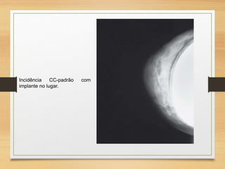 Incidência CC-padrão com
implante no lugar.
 