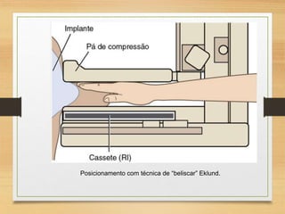 Posicionamento com técnica de “beliscar” Eklund.
 