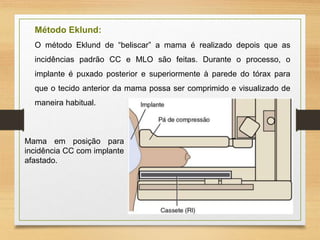 Método Eklund:
O método Eklund de “beliscar” a mama é realizado depois que as
incidências padrão CC e MLO são feitas. Durante o processo, o
implante é puxado posterior e superiormente à parede do tórax para
que o tecido anterior da mama possa ser comprimido e visualizado de
maneira habitual.
Mama em posição para
incidência CC com implante
afastado.
 