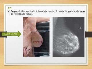 RC
 Perpendicular, centrado à base da mama, à borda da parede do tórax
do RI; RC não móvel.
Incidência ML
 