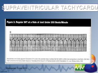 defibrillation and cardioversion | PPT
