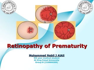 Retinopathy of Prematurity
Mohammed Nabil J AlAli
5th year medical student
At King Faisal University
Group B (210006209)

Powerpoint Templates

Page 1

 