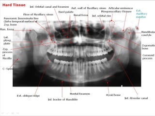 Hard Tissue

Inf. Orbital canal and foramen Ant. wall of Maxillary sinus Articular eminence
Ptregomaxillary Fissure
Hard palate
Floor of Maxillary sinus
Nasal fossa Inf. orbital rim
Panoramic Innominate line
(Infra temporal surface of
Zyg. bone

Man. fossa

Ext.
Auditory
meatus

Mandibular
condyle

Lat.
ptreg.
plate

Zygomatic
bone

Zyg.
process
of
Maxilla

Coronoid
process

C- Spine

Ext. oblique ridge

Mental foramen
Inf. border of Mandible

Powerpoint Templates

Hyoid bone
Inf. Alveolar canal

Page 17

 