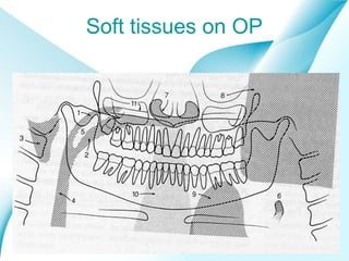 Soft tissues on OP

Powerpoint Templates

Page 18

 