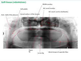Soft tissue (edentulous)
Middle meatus
Inf. nasal meatus

Soft palate

Inf. nasal concha (turbinate)
Post. Wall of the pharynx

Dorsal surface of the tongue

Upper
lip

Lower lip

Ghost image of opposite Man.

Powerpoint Templates

Page 19

 