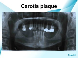 Carotis plaque

Powerpoint Templates

Page 28

 