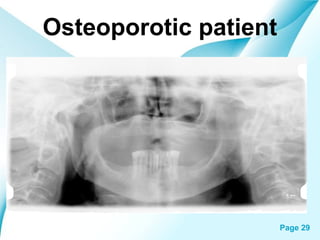 Osteoporotic patient

Powerpoint Templates

Page 29

 