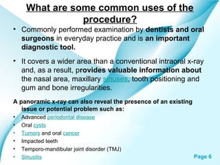 What are some common uses of the
procedure?
• Commonly performed examination by dentists and oral
surgeons in everyday practice and is an important
diagnostic tool.
• It covers a wider area than a conventional intraoral x-ray
and, as a result, provides valuable information about
the nasal area, maxillary sinuses, tooth positioning and
gum and bone irregularities.
A panoramic x-ray can also reveal the presence of an existing
issue or potential problem such as:
•
•
•
•
•
•

Advanced periodontal disease
Oral cysts
Tumors and oral cancer
Impacted teeth
Temporo-mandibular joint disorder (TMJ)
Powerpoint Templates
Sinusitis

Page 6

 