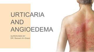URTICARIA
AND
ANGIOEDEMA
SUPERVISED BY
DR / Bassam Al─Drassi
 