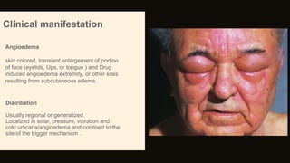 Angioedema
skin colored, transient enlargement of portion
of face (eyelids, Ups, or tongue ) and Drug
induced angioedema extremity, or other sites
resulting from subcutaneous edema.
Clinical manifestation
Diatribation
Usually regional or generalized.
Locallzed in solar, pressure, vibration and
cold urticaria/angioedema and contined to the
site of the trigger mechanism .
 