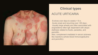 Clinical types
Evolves over days to weeks < 6 w .
Acute onset and recurring over <30 days .
Usually large wheals are often associated with
angioedema often IgE dependent with atopic
diathesis related to foods, parasites, and
penicillin.
Also, complement mediated in serum sickness
like reactions (whole blood Immunoglobulins
and penicillin).
ACUTE URTICARIA
 
