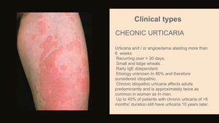 Urticaria and / or angioedema alasting more than
6 weeks
Recurring over > 30 days.
Small and latge wheals .
Rarly IgE ddependent.
Etiology unknown In 80% and therefore
oonsidered idiopathic.
Chronic idiopathic urticaria affects adults
predominantly and is approximately twice as
common in women as In men.
Up to 40% of patients with chronic urticaria of >6
months' duration still have urticaria 10 years later.
Clinical types
CHEONIC URTICARIA
 