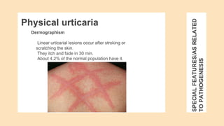 SPECIAL
FEATURES/AS
RELATED
TO
PATHOGENESIS
Dermographism
Linear urticarial lesions occur after stroking or
scratching the skin.
They itch and fade in 30 min.
About 4.2% of the normal population have it.
Physical urticaria
 