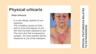 SPECIAL
FEATURES/AS
RELATED
TO
PATHOGENESIS
Solar Urticaria
Is a rare allergic reaction to sun
exposure.
The condation causes an itchy
rash or hives that appear on any
skin that has been exposed to sun.
The more skin that is exposed to
sunlight , the more reaction will be.
Histamine is one of the mediators.
Physical urticaria
 