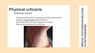 SPECIAL
FEATURES/AS
RELATED
TO
PATHOGENESIS
Cholinergic urticaria
Exercise to the point of sweating provokes typical small,
papular, highly pruritic urticarial lesion .
Occurring within 30 min of vigorous exercise .
May be accompanied by wheezing.
Physical urticaria
 