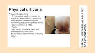 SPECIAL
FEATURES/AS
RELATED
TO
PATHOGENESIS
Pressure Angioedema
Erythematous swelling induced by
sustained pressure (buttock swelling
when seated, hand swelling after
hammering, foot swelling after walking).
Delayed (30 min to 12 h).
Painful .
May persist for several days, and
interferes with quality of life.
No laboratory abnormalities, fever may
occur.
Physical urticaria
 