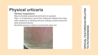 SPECIAL
FEATURES/AS
RELATED
TO
PATHOGENESIS
VIbration Angioedema
May be familial (autosomal dominant) or sporadic.
Rare , it is believed to result from histamine release from mast
cells caused by a vibrating stimulus rubbing a towel across the
back produces lesions.
But direct pressure (without movements) does not.
Physical urticaria
 