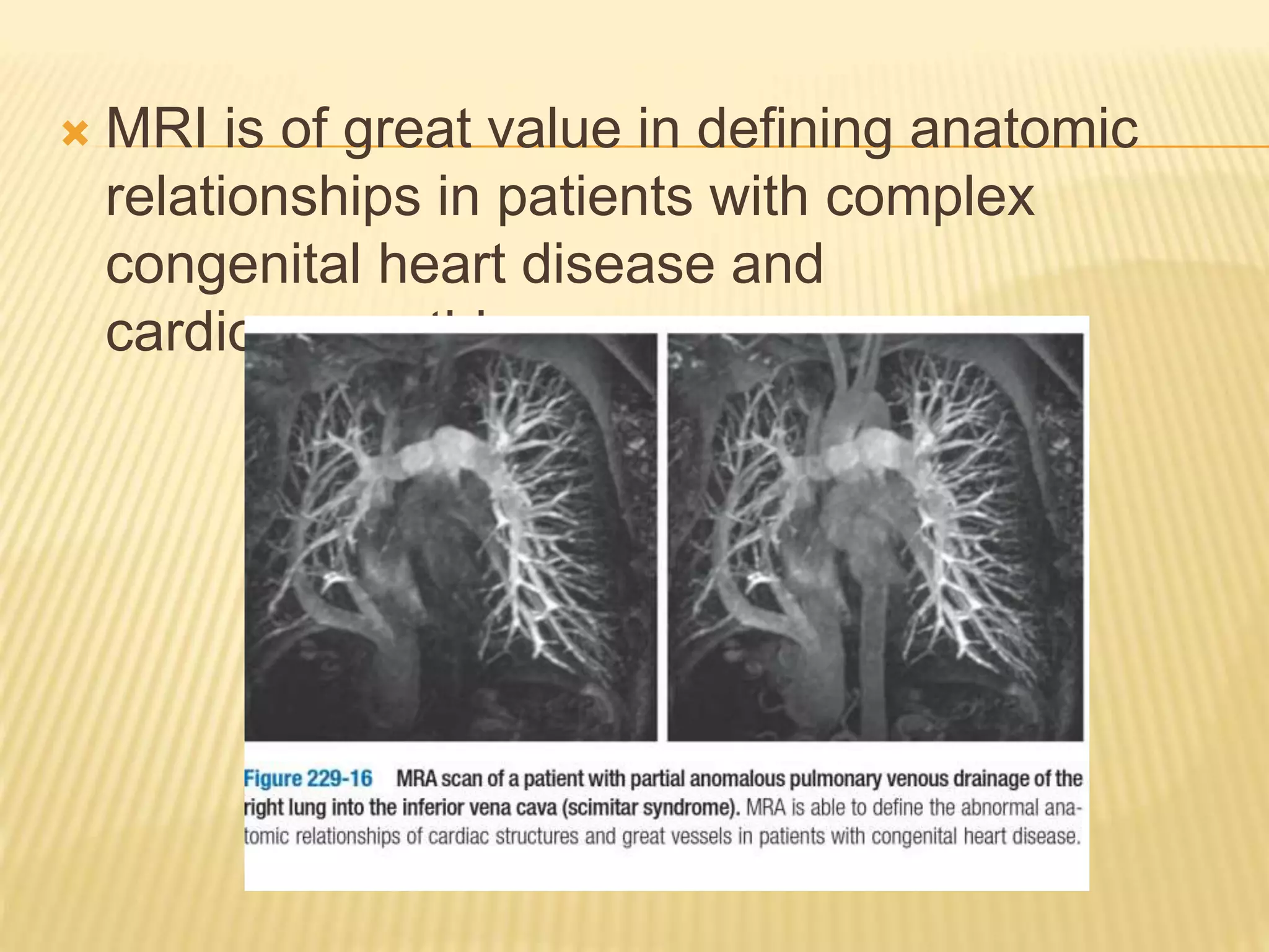  MRI is of great value in defining anatomic
relationships in patients with complex
congenital heart disease and
cardiomyopathies
 