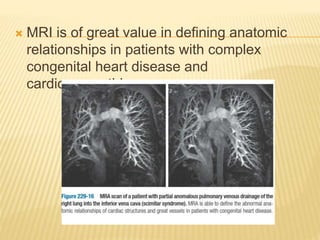  MRI is of great value in defining anatomic
relationships in patients with complex
congenital heart disease and
cardiomyopathies
 