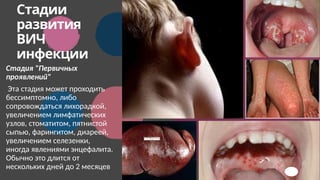 Стадии
развития
ВИЧ
инфекции
Стадия "Первичных
проявлений"
Эта стадия может проходить
бессимптомно, либо
сопровождаться лихорадкой,
увеличением лимфатических
узлов, стоматитом, пятнистой
сыпью, фарингитом, диареей,
увеличением селезенки,
иногда явлениями энцефалита.
Обычно это длится от
нескольких дней до 2 месяцев 6
 