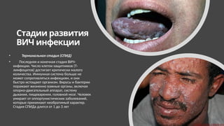 Стадии развития
ВИЧ инфекции
• Терминальная стадия (СПИД)
• Последняя и конечная стадия ВИЧ-
инфекции. Число клеток-защитников (Т-
лимфоцитов) достигает критически малого
количества. Иммунная система больше не
может сопротивляться инфекциям, и они
быстро истощают организм. Вирусы и бактерии
поражают жизненно важные органы, включая
опорно-двигательный аппарат, систему
дыхания, пищеварения, головной мозг. Человек
умирает от оппортунистических заболеваний,
которые принимают необратимый характер.
Стадия СПИДа длится от 1 до 3 лет
 