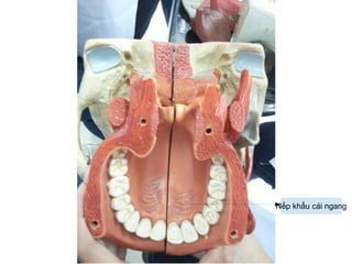 Nếp khẩu cái ngang
 