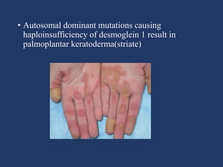 • Autosomal dominant mutations causing
haploinsufficiency of desmoglein 1 result in
palmoplantar keratoderma(striate)
 