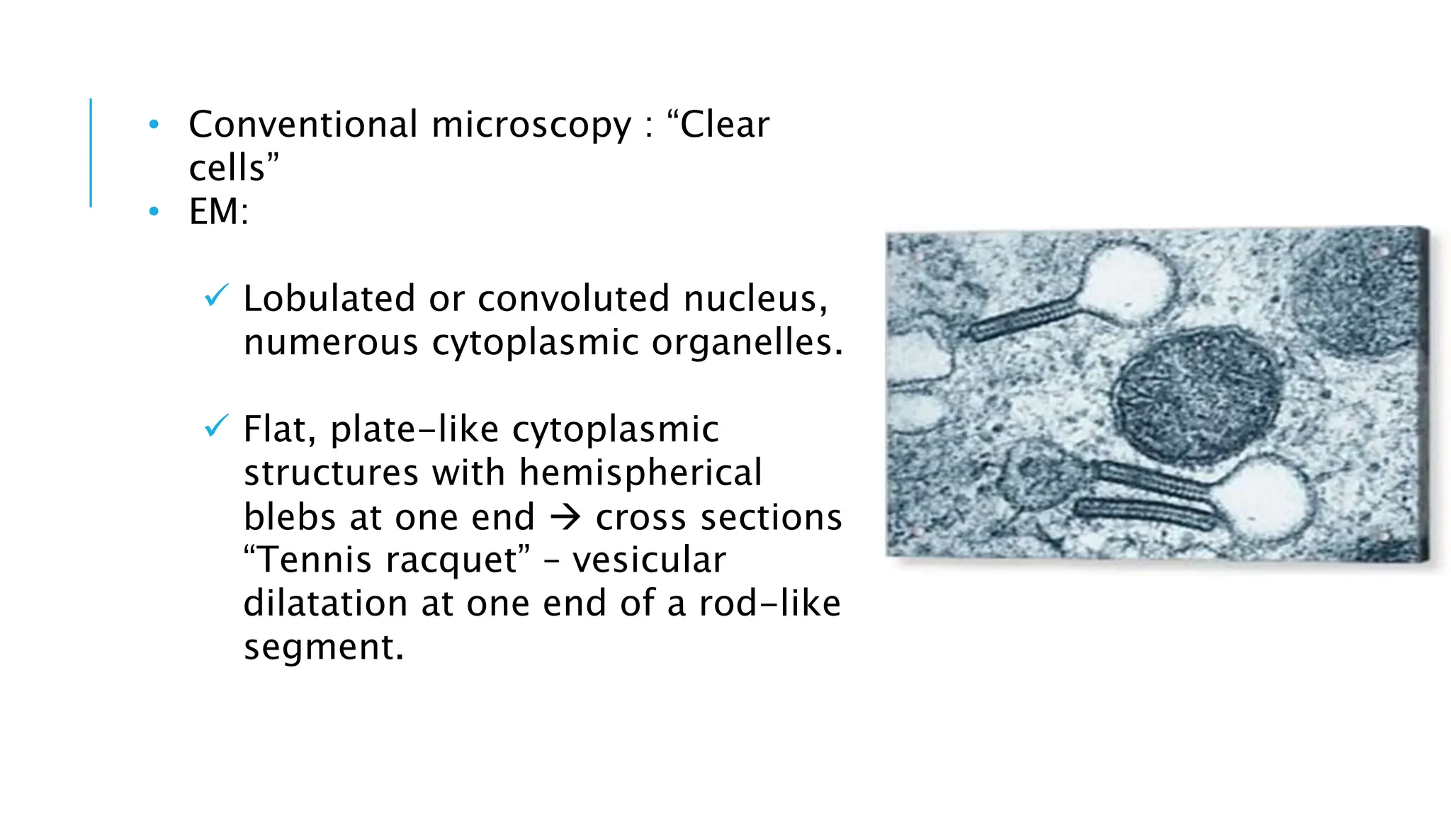 • Conventional microscopy : “Clear
cells”
• EM:
 Lobulated or convoluted nucleus,
numerous cytoplasmic organelles.
 Flat, plate-like cytoplasmic
structures with hemispherical
blebs at one end  cross sections
“Tennis racquet” – vesicular
dilatation at one end of a rod-like
segment.
 