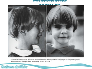 Alteraciones
                                    Faciales




Castriota A. Dallapiccola B. Hands. En: Abnormal Skeletal Phenotypes From Simple Signs to Complex Diagnoses.
Berlin, Alemania: Springer-Berlin Heilderberg; 2005. P. 361-454.
 
