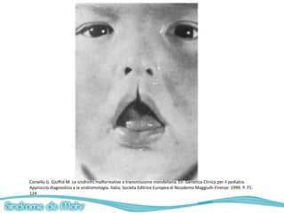 Corsello G. Giuffré M. Le sindromi malformative a transmissione mendeliana. En: Genetica Clinica per il pediatra.
Approccio diagnostico a la sindromologia. Italia; Societa Editrice Europea di Nicodemo Maggiulli-Firenze: 1999. P. 71-
124
 