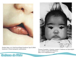 Naohiko Sakai, et al. Oral-Facial-Digital Syndrome Type II (Mohr
Syndrome): Clinical and genetic manifestations                     Guerrero Fernandez J. Guerrero vazquéz J. Sindrome oro fácial-digital
                                                                   tipo I, Madrid, Españá Web PEDiátrica
                                                                   [http://www.webpediatrica.com]
 