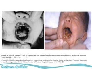 Young L. Wilhelm L. Zuppan C. Clark R., Naumoff sort ribo polidactyly sindrome compunded whit Mohr oral- facial-digital siindrome
Pediatr Radiol(2001) 31: 31-35.
 Corsello G. Giuffré M. Le sindromi malformative a transmissione mendeliana. En: Genetica Clinica per il pediatra. Approccio diagnostico
 a la sindromologia. Italia; Societa Editrice Europea di Nicodemo Maggiulli-Firenze: 1999. P. 71-124
 