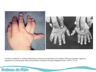 Corsello G. Giuffré M. Le sindromi malformative a transmissione mendeliana. En: Genetica Clinica per il pediatra. Approccio
diagnostico a la sindromologia. Italia; Societa Editrice Europea di Nicodemo Maggiulli-Firenze: 1999. P. 71-124
 