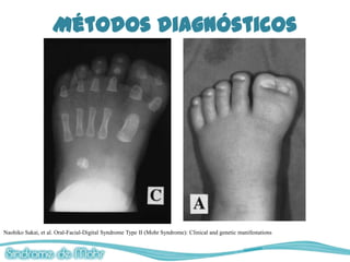 Métodos diagnósticos




Naohiko Sakai, et al. Oral-Facial-Digital Syndrome Type II (Mohr Syndrome): Clinical and genetic manifestations
 