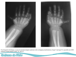 Yiu Chung W., Po Chung L. A case of oral-facial-digital syndrome with overlapping manifestations of type V and type VI: a possible new OFD
syndrome Pediatr Radiol (1999) .29: 268-271
 