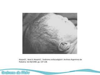 Alazard E. Kerai V. Alazard C. Sindrome orofaciodigital I. Archivos Argentinos de
Pediatria. Vol.96/1998. pp. 137-138.
 