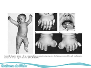 Kennet L. Defectos faciales y de las extremidades como características mayores. En: Patrones reconocibles de la malformación
humana. 6ª edición. España: Elsevier; 2007. P. 286-337.
 