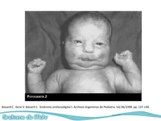 Alazard E. Kerai V. Alazard C. Sindrome orofaciodigital I. Archivos Argentinos de Pediatria. Vol.96/1998. pp. 137-138.
 