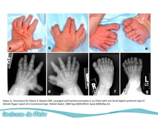 Hayes LL, Simoneaux SF, Palasis S, Niyazov DM. Laryngeal and tracheal anomalies in an infant with oral-facial-digital syndrome type VI
(Váradi-Papp): report of a transitional type. Pediatr Radiol. 2008 Sep;38(9):994-8. Epub 2008 May 14.
 