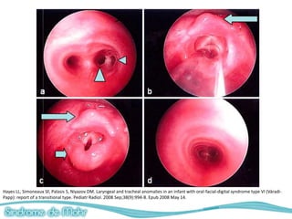 Hayes LL, Simoneaux SF, Palasis S, Niyazov DM. Laryngeal and tracheal anomalies in an infant with oral-facial-digital syndrome type VI (Váradi-
Papp): report of a transitional type. Pediatr Radiol. 2008 Sep;38(9):994-8. Epub 2008 May 14.
 