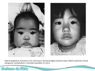 Sakai N, Nakakita N, Yamazaki Y, Ui K, Uchinuma E. Oral-facial-digital syndrome type II (Mohr syndrome): clinical
and genetic manifestations. J Craniofac Surg 2002; 13: 321-6.
 
