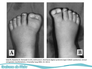 Sakai N, Nakakita N, Yamazaki Y, Ui K, Uchinuma E. Oral-facial-digital syndrome type II (Mohr syndrome): clinical
and genetic manifestations. J Craniofac Surg 2002; 13: 321-6.
 