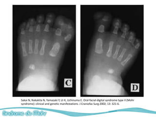 Sakai N, Nakakita N, Yamazaki Y, Ui K, Uchinuma E. Oral-facial-digital syndrome type II (Mohr
syndrome): clinical and genetic manifestations. J Craniofac Surg 2002; 13: 321-6.
 