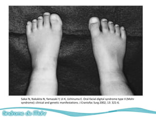 Sakai N, Nakakita N, Yamazaki Y, Ui K, Uchinuma E. Oral-facial-digital syndrome type II (Mohr
syndrome): clinical and genetic manifestations. J Craniofac Surg 2002; 13: 321-6.
 