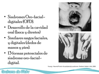 • Síndromes Oro-facial-
  digitales (OFD).
• Desarrollo de la cavidad
  oral (boca y dientes)
• Similares rasgos faciales,
  y digitales (dedos de
  manos y pies).
• 13 formas potenciales de
  síndrome oro-facial-
  digital.
                               Young L. Naumoff short-rib polydactyly syndrome. Pediatric Radiol. USA; 2000.
 