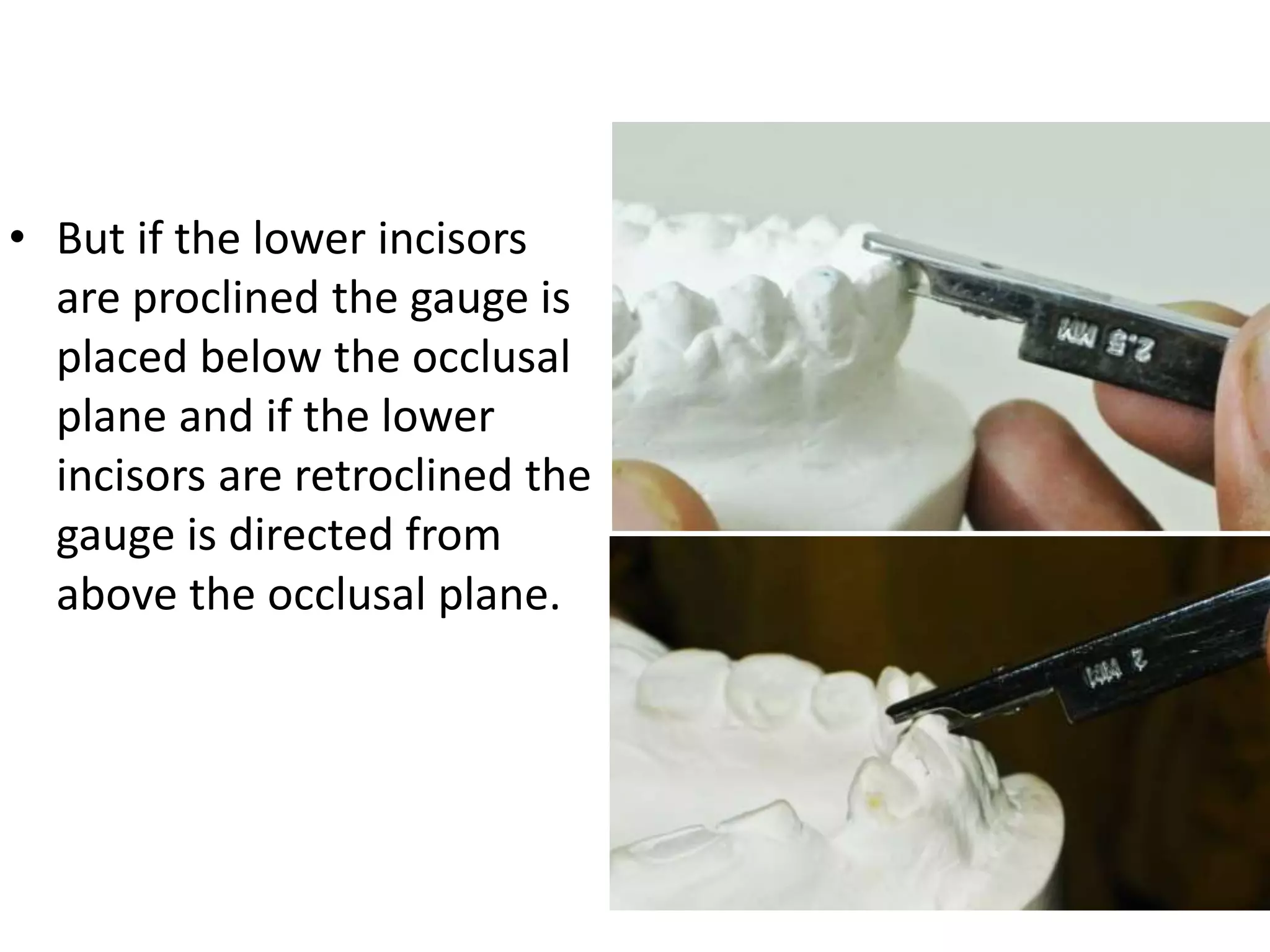 • But if the lower incisors
are proclined the gauge is
placed below the occlusal
plane and if the lower
incisors are retroclined the
gauge is directed from
above the occlusal plane.
 