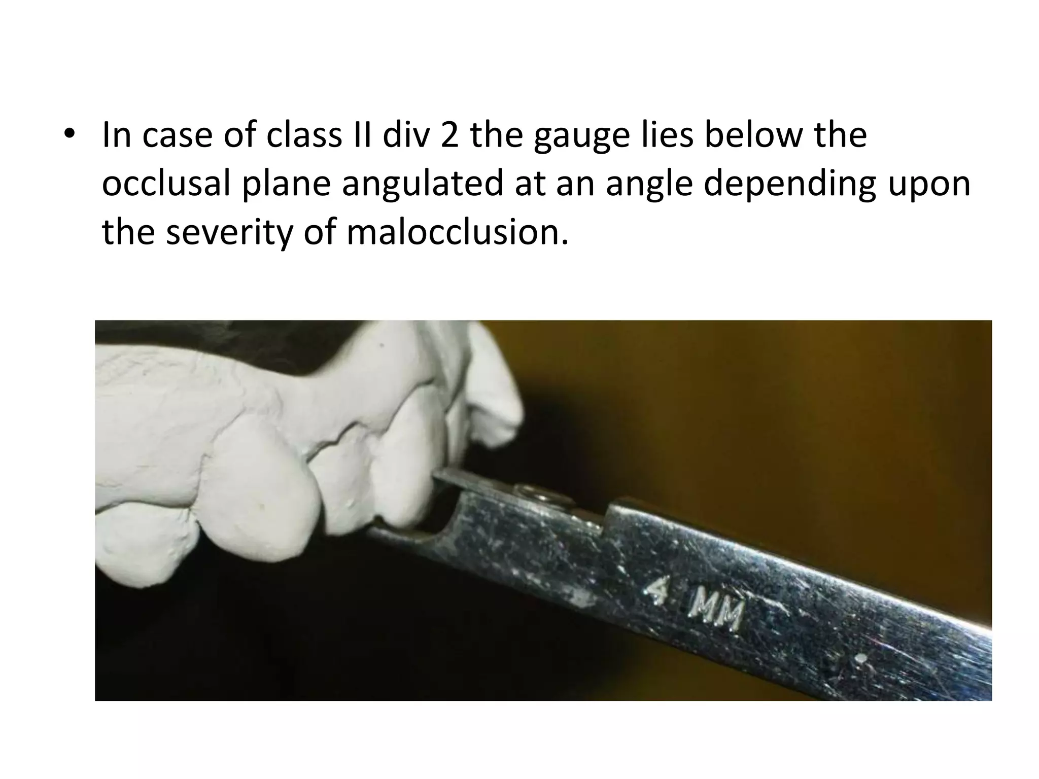• In case of class II div 2 the gauge lies below the
occlusal plane angulated at an angle depending upon
the severity of malocclusion.
 