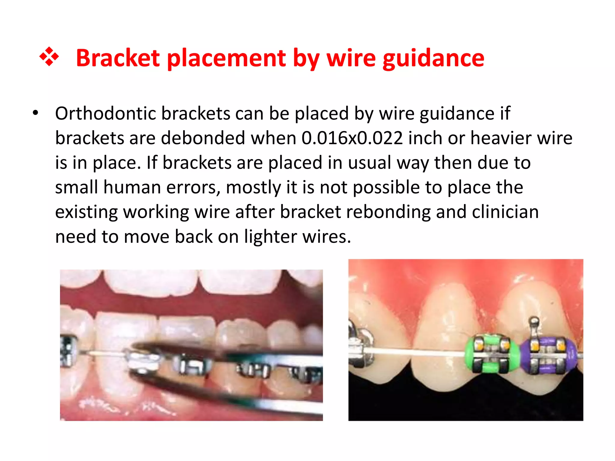• Orthodontic brackets can be placed by wire guidance if
brackets are debonded when 0.016x0.022 inch or heavier wire
is in place. If brackets are placed in usual way then due to
small human errors, mostly it is not possible to place the
existing working wire after bracket rebonding and clinician
need to move back on lighter wires.
 Bracket placement by wire guidance
 
